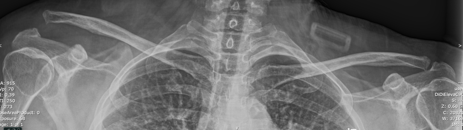 Secuencia clínica luxación AC crónica, imagen 1